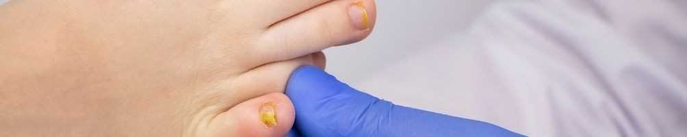 Prodotti per il trattamento di unghie fragili, macchiate, ispessite, rovinate dalle infezioni.