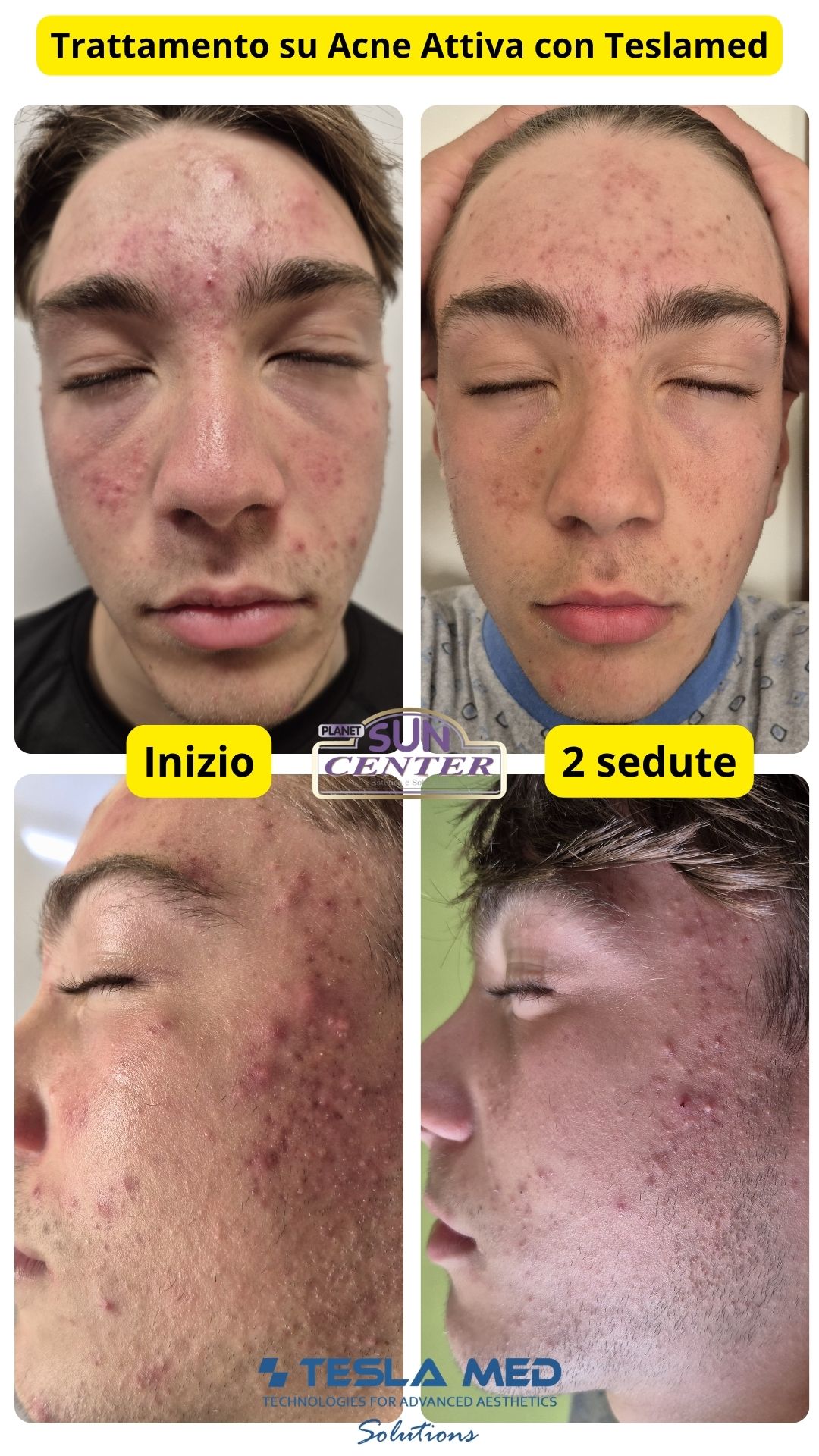 Prima e dopo trattamento acne attiva TeslaMed a Sulmona