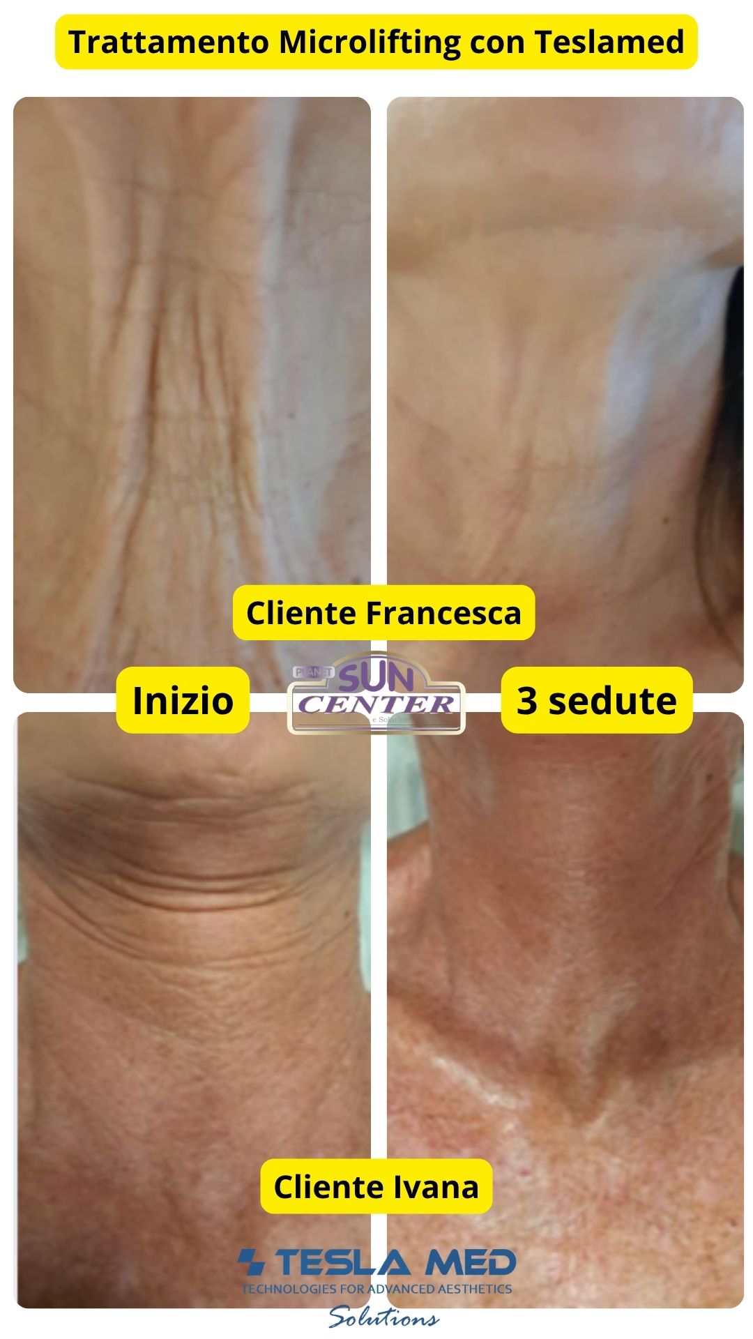 Prima e dopo trattamento TeslaMed Microlifting a Sulmona